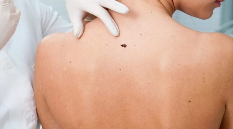 Clicca per accedere all'articolo Prevenzione del Melanoma cutaneo: una giornata nazionale